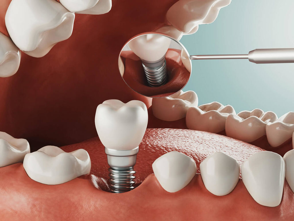 Dental Implants - High Point, NC - Byrd Ford Dentistry