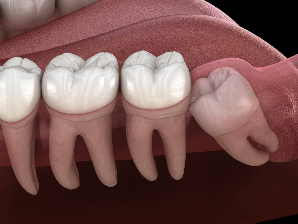 illustration of impacted wisdom tooth in mouth
