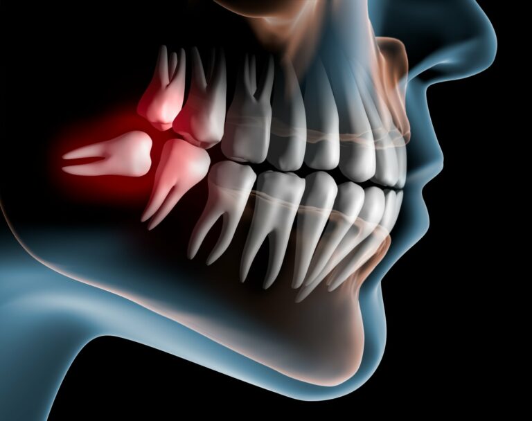 impacted wisdom teeth in mouth